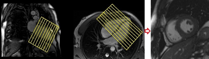 cardiac mri protocols and planning of short axis cine