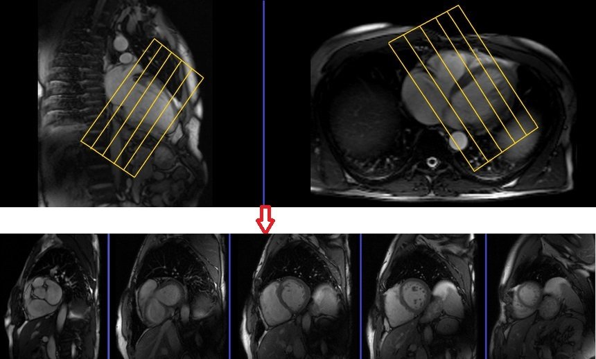 cardiac mri protocols and planning of short axis localizer