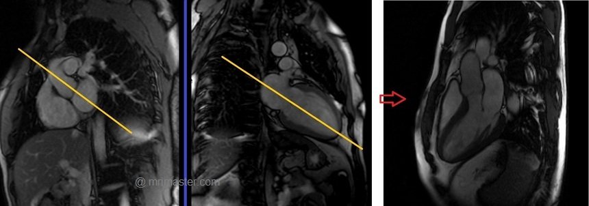 cardiac mri protocols and planning of three chamber cine