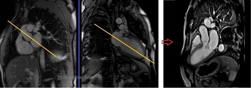 cardiac mri protocols and planning of three chamber post gd