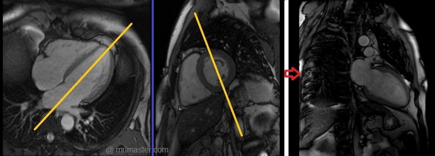 cardiac mri protocols and planning of two chamber cine