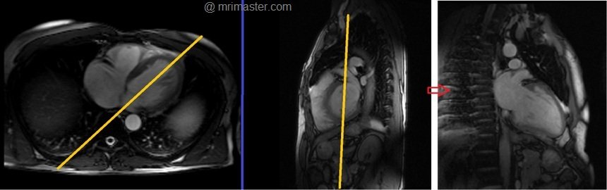 cardiac mri protocols and planning of two chamber localizer