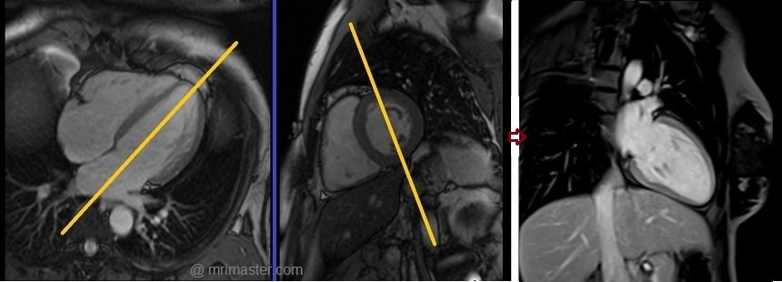 cardiac mri protocols and planning of two chamber post gd