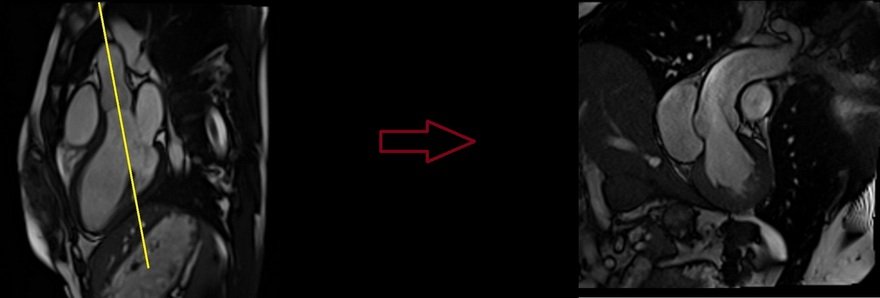 left ventricular outflow tract (LVOT) CARDIAC MRI PLANNING