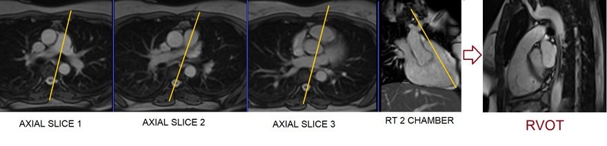 right ventricular outflow tract (RVOT) cardiac MRI planning image