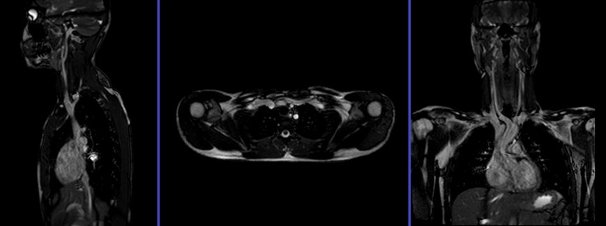 magnetic resonance angiography(MRA) whole body chest and nek localizer
