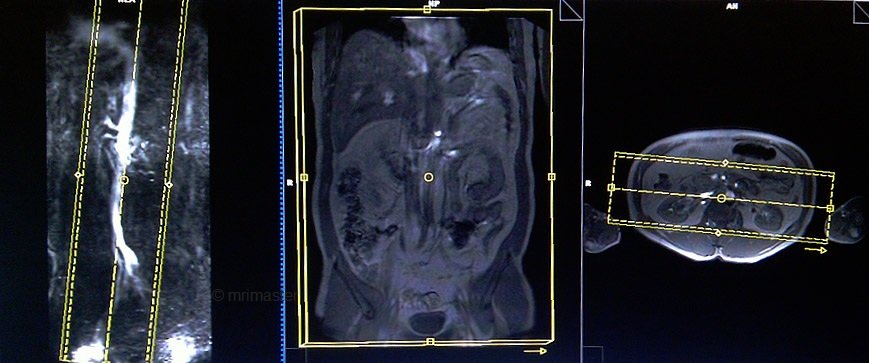 magnetic resonance angiography(MRA) whole body protocols and planning of abdomen post contrast scans