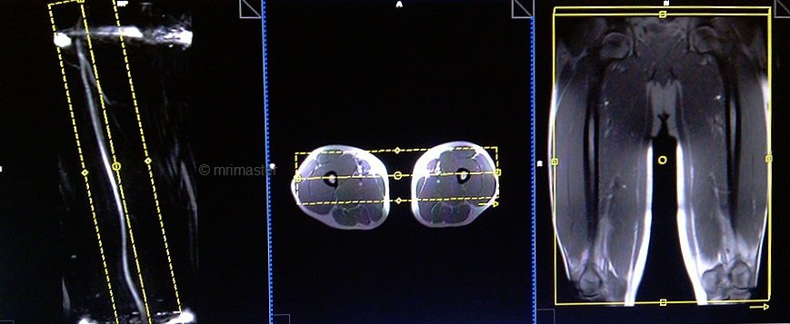 magnetic resonance angiography(MRA) whole body protocols and planning of upper leg scans