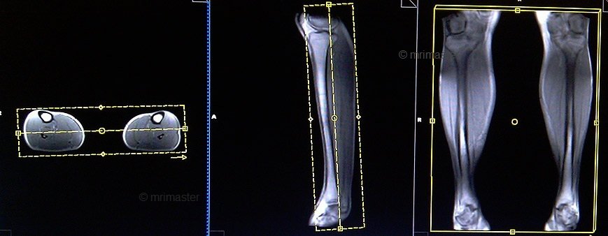 magnetic resonance angiography(MRA) whole body protocols and planning of lower legs post contrast scans