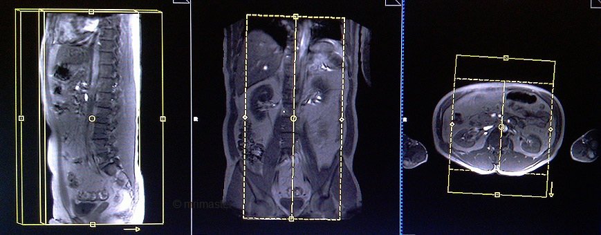 magnetic resonance angiography(MRA) whole body sagittal phase contrast localizer