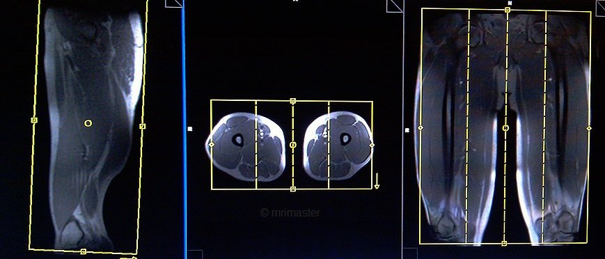 magnetic resonance angiography(MRA) whole body vessel localizer upper leg