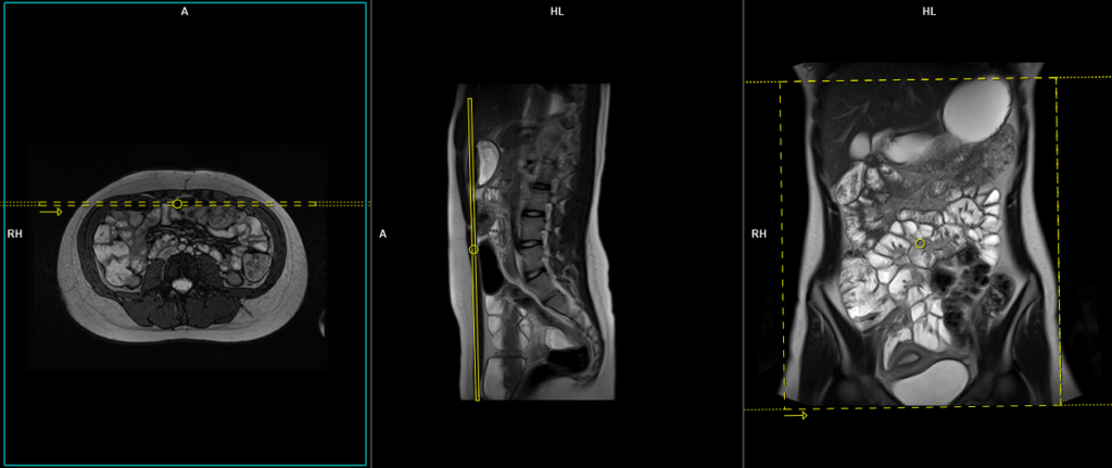 How to perform and interpret cine MR enterography. MRI protocol and planning image 1