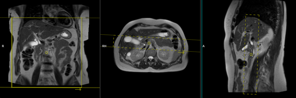 MRCP planning and protocol of coronal haste thick slab bile duct and pancreatic duct