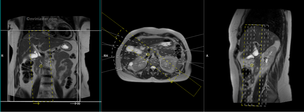 MRCP planning and protocol of coronal haste thick slab radial scans