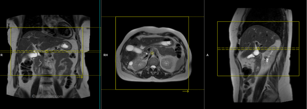 MRCP planning and protocol of axial slices