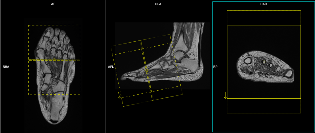 MRI FOOT PLANNING OF AXIAL IMAGES