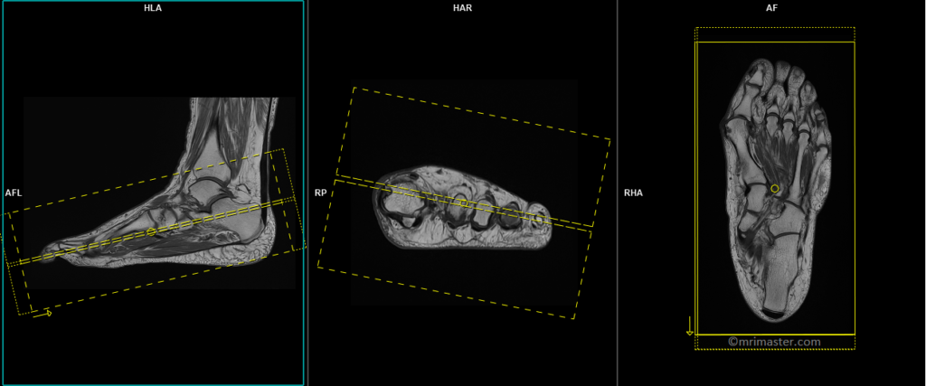 MRI FOOT PLANNING OF CORONAL IMAGES