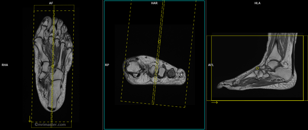 MRI FOOT PLANNING OF SAGITTAL IMAGES