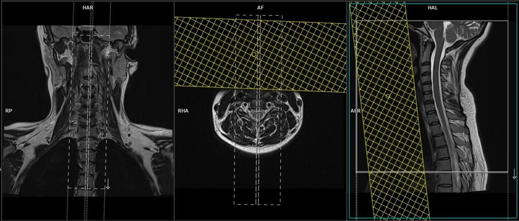 MRI PANING AND PROTOCOL OF C SPINE SAGITTAL