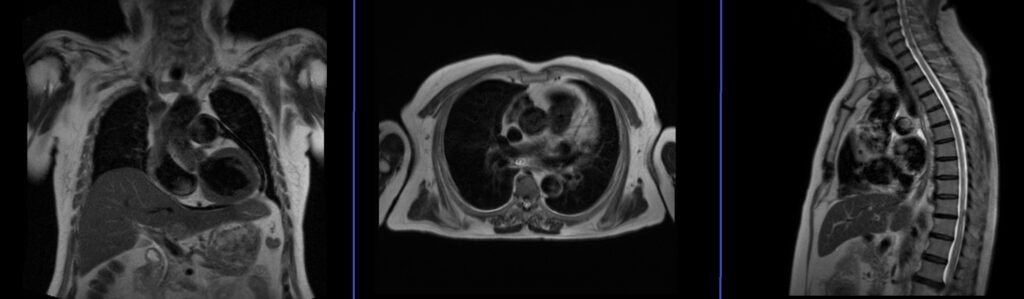 MRI chest localizer