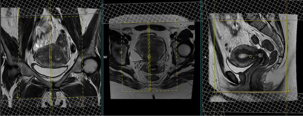 MRI gynaecology pelvis (endometrial protocol) Sagittal t2 scan planning