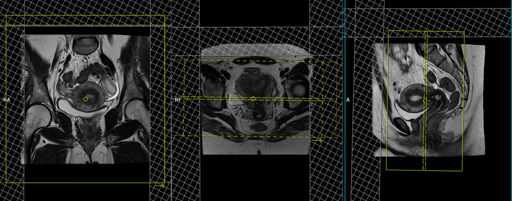 MRI gynaecology pelvis (endometrial protocol) axial DWI scan planning