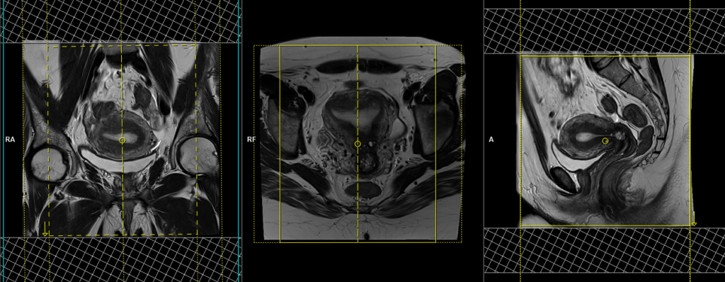 MRI gynaecology pelvis (endometrial protocol) sagital scan planning