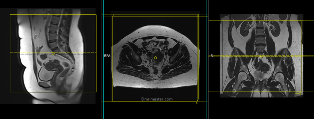 MRI gynecology pelvis large FOV axial planning and protocol