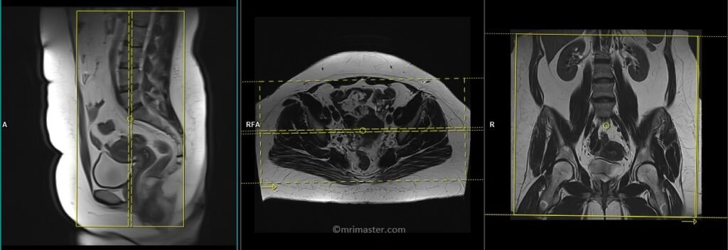 MRI gynecology pelvis large FOV coronal planning and protocol