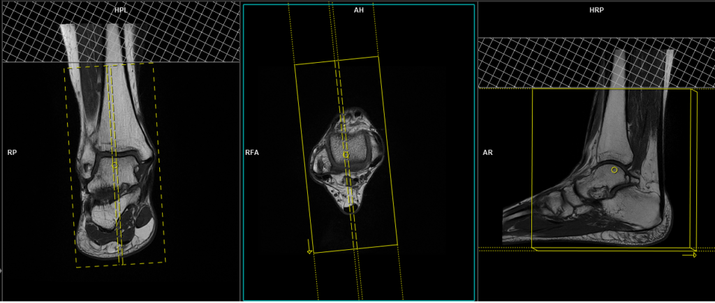 MRI planning and protocol of ankle sagittal