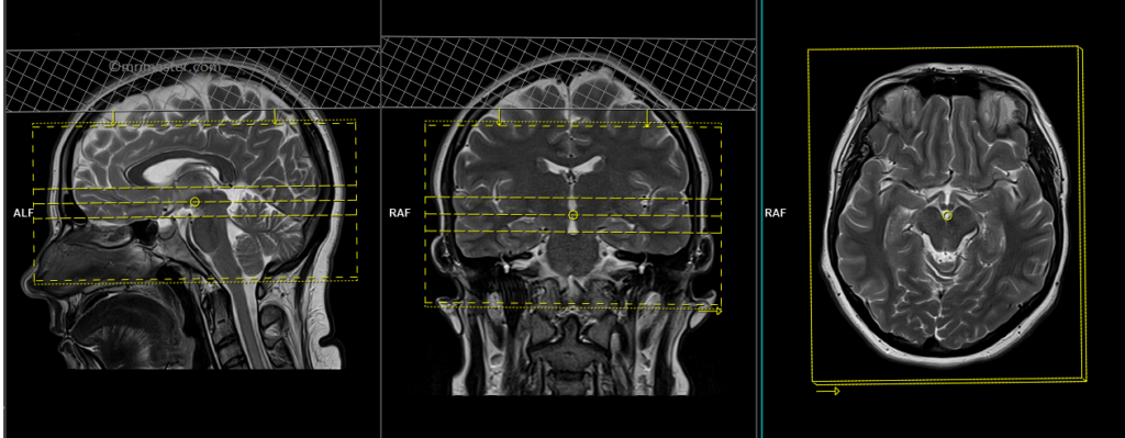 MRI planning and protocol of Circle of Willis Magnetic Resonance Angiography