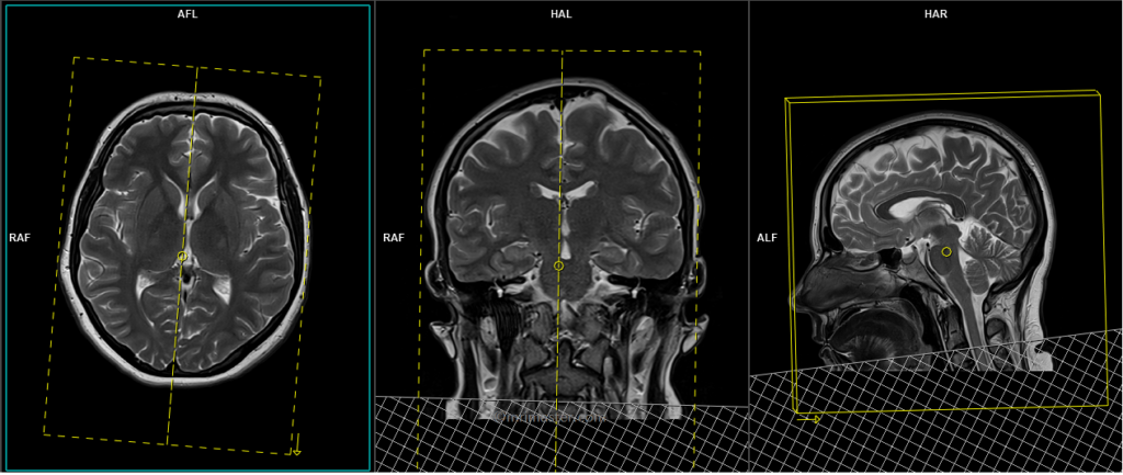 MRI protocol and planning of MRV brain PC 3D scan