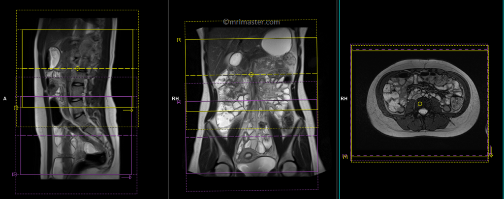 MRI small bowel (enterography) axial planning and protocol of DIXON scan
