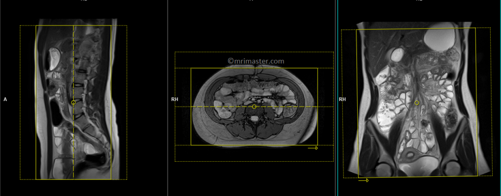 MRI small bowel (enterography) coronal flash planning and protocols
