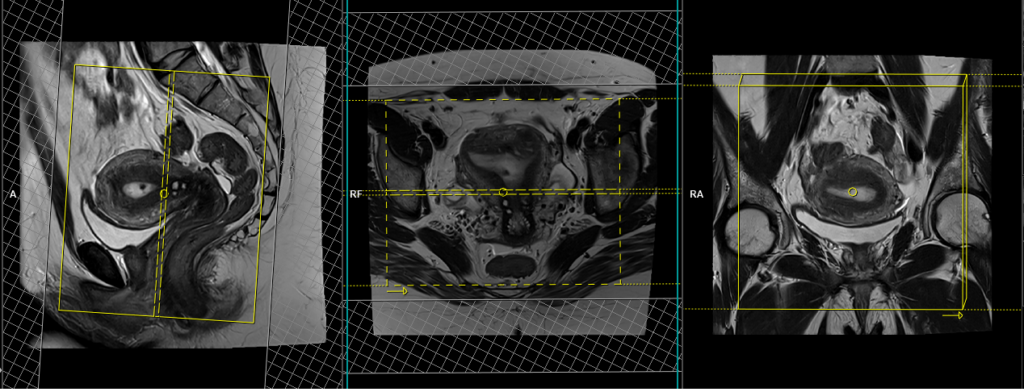 gyne pelvis mri planning of axial small FOV t2