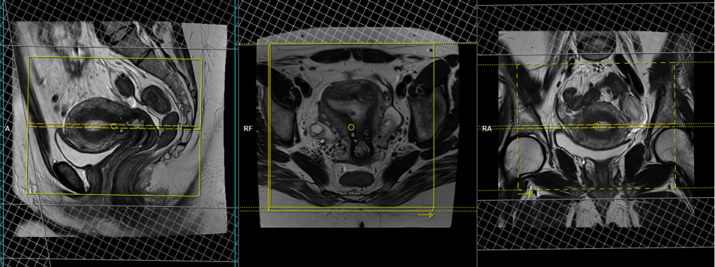 gyne pelvis mri planning of coronal small FOV t2