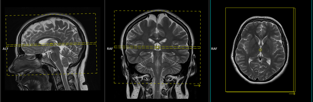 mri brain protocol and planning of axial scans