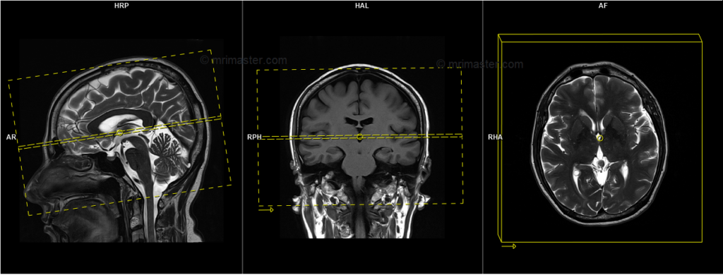 mri brain protocol and planning of axial scans