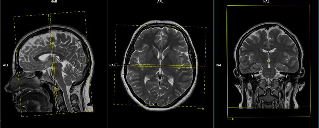 mri brain protocol and planning of coronal scansscans