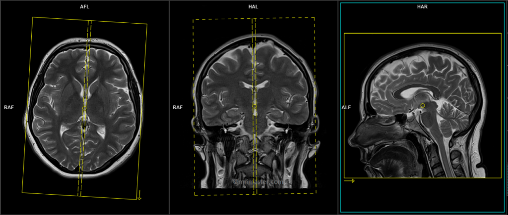 mri brain protocol and planning of sagittal scans