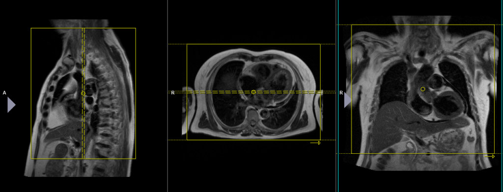 mri chest coronal planning