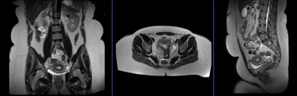 mri gyne pelvis localizer
