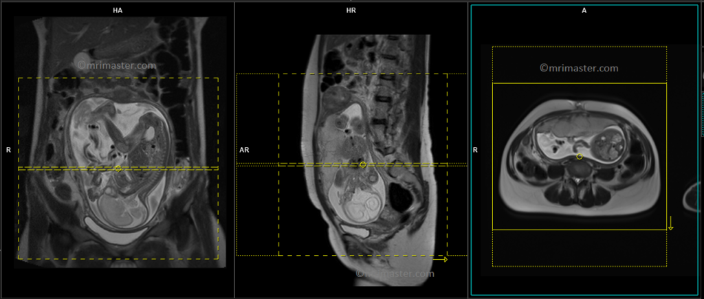 mri placenta axial planning and protocol