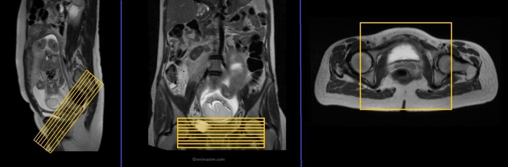 mri placenta birth canal axial planning