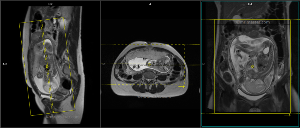 mri placenta coronal planning