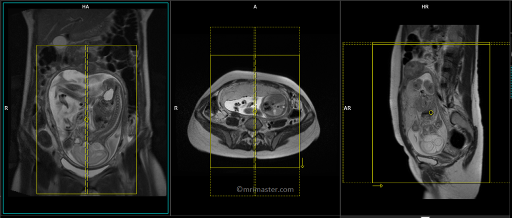 mri placenta sagittal planning