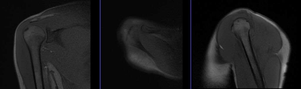 mri shoulder localizer planning image