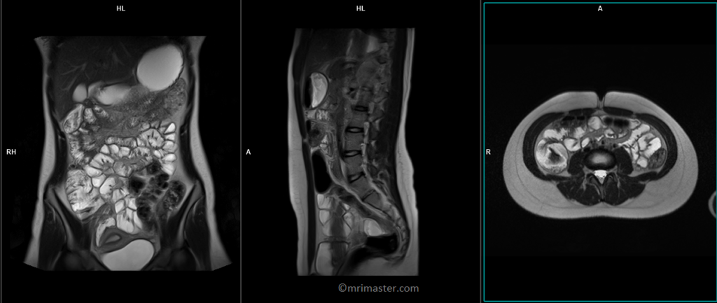 mri small bowel localizer image