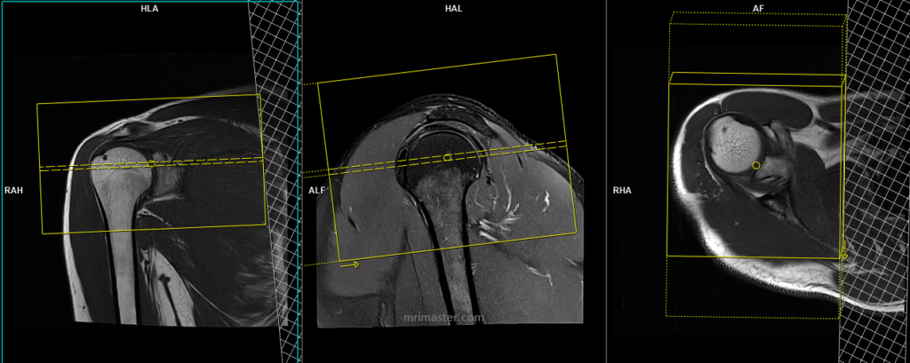 planning and protocol of shoulder mri axial scans