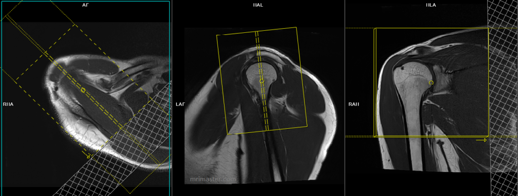 planning and protocol of shoulder mri coronal scans